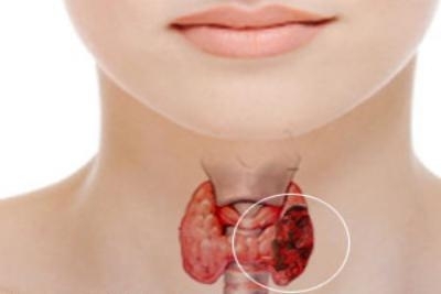 Komplet analize 3 hormona štitne žlezde FT3, FT4 i TSH | Popust